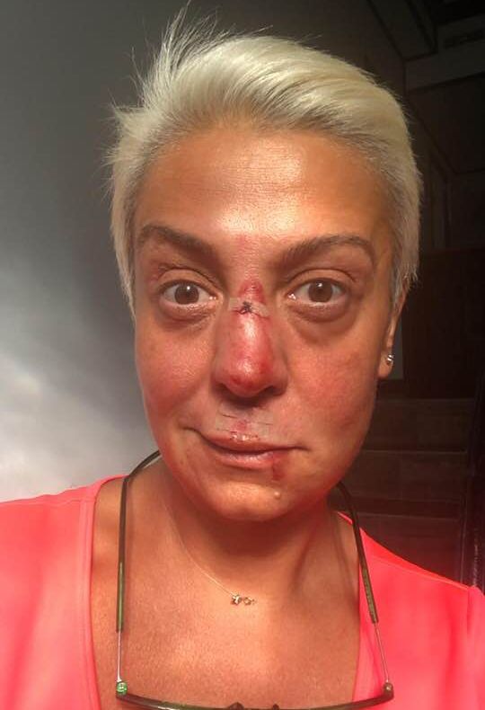 Monica Anghel, directoarea artistică a Centrului Cultural Argeş, desfigurată în urma unui accident