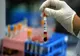  Un test de sânge ar putea detecta cancerul mamar cu cinci ani înaintea primelor simptome 