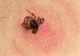 Atenție la căpușe! Șapte persoane, diagnosticate cu boala Lyme în Argeș